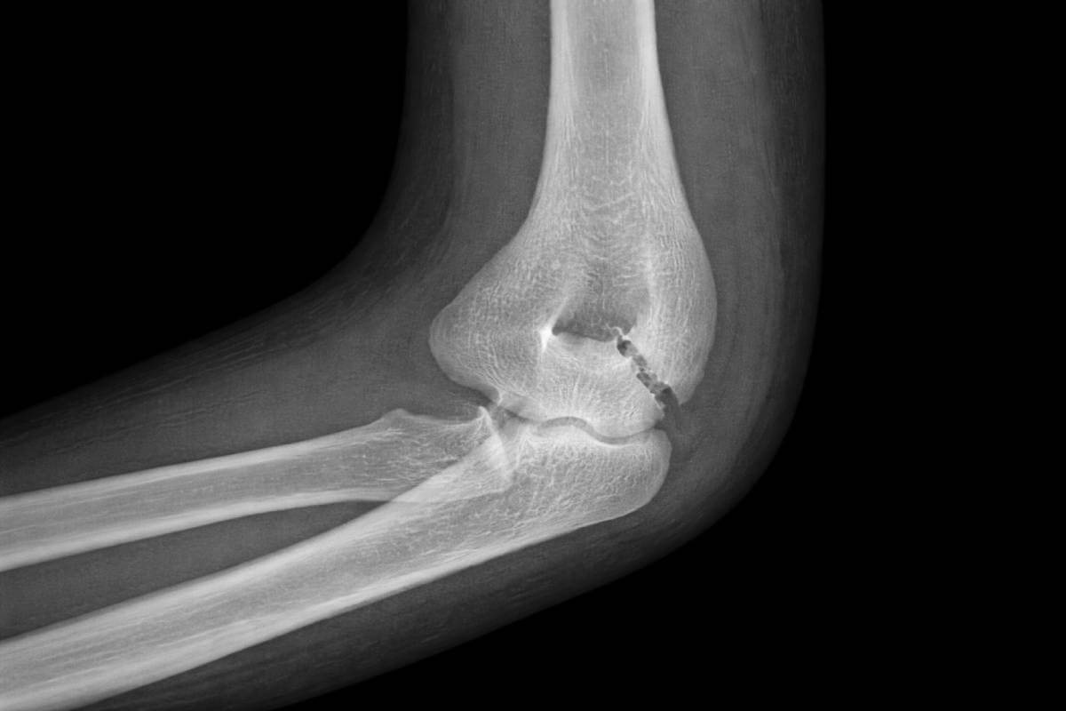 Frattura del gomito: rimedi per la rigidità, esercizi e tempi di recupero