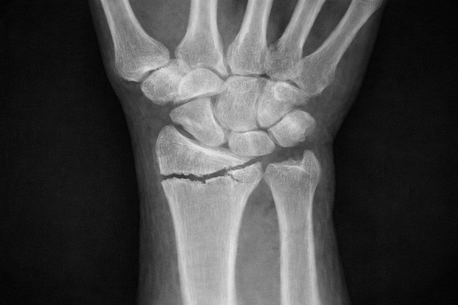 Frattura del gomito: rimedi per la rigidità, esercizi e tempi di recupero